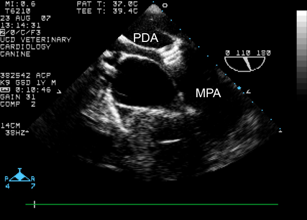 Transesophageal echocardiogram showing ACDO deployment